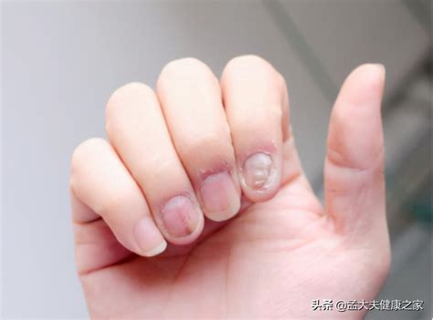 怎么治灰指甲最简单有效（得了灰指甲怎么治？2个治疗方法效果好，安全不复发） | 说明书网