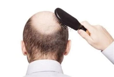 现在秃头的现象越来越普遍，那么到底秃头是什么原因造成的呢？__凤凰网
