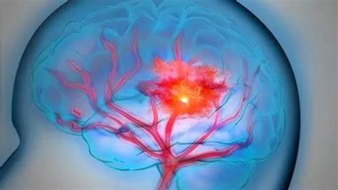 神经综述：脑出血后脑水肿药物治疗的研究进展_医学界-助力医生临床决策和职业成长