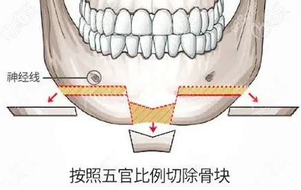 弄清楚颏成型和正颌区别，才知道下颌后缩做正颌还是颏成型?整形案例 - 北京圣嘉新医疗美容医院 - 炫美网