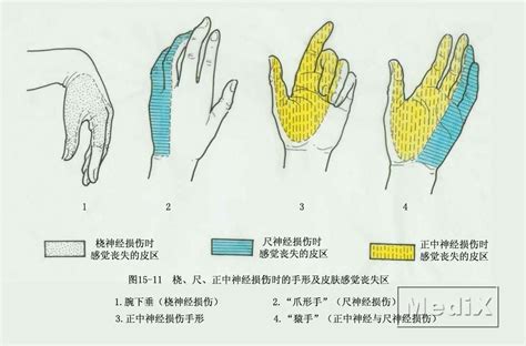 尺神经损伤爪形手,正中损猿手,尺恢复锻炼图(第3页)_大山谷图库