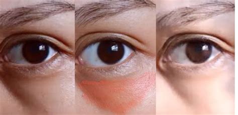 黑眼圈是怎么回事，怎么消除黑眼圈_上海美莱医疗美容【官网】