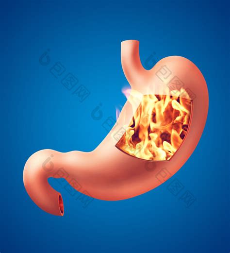 胃食管反流病胃酸倒流胃灼热和食管反流图表-包图企业站