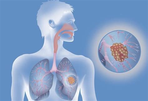 早期肺癌有什么症状？早期肺癌检查项目都有什么-盛诺一家