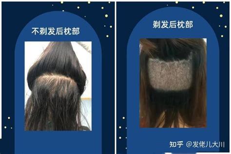 头发加密种植后要注意哪些事项？_上海美莱医疗美容