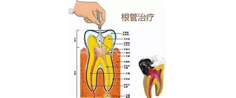 牙齿根管治疗需要多少费用？_广州穗华口腔医院【官网】