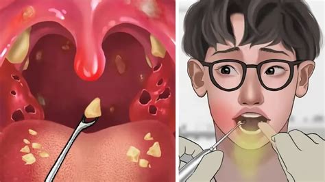 扁桃体结石图片