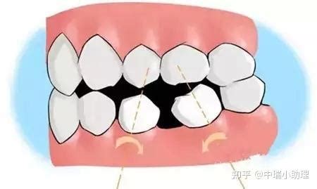 矫牙后真的会导致牙齿松动，老了掉牙吗？ - 知乎