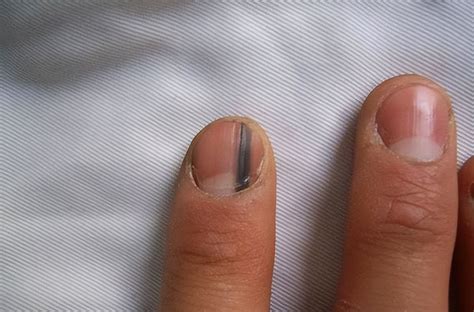指甲上的月牙突然消失，别大意，或许是身体病变发出的信号
