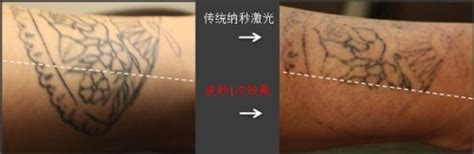 小哥大臂龙纹身图案皮秒洗纹身第五次效果案例比对 - 皮秒激光洗纹身案例 武汉老兵纹身
