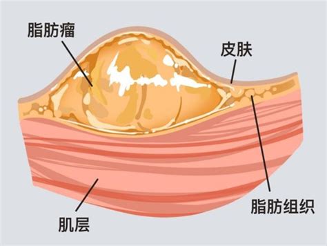 背部长瘤大全图片