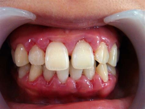 牙龈瘤初期图片 (33)_有来医生