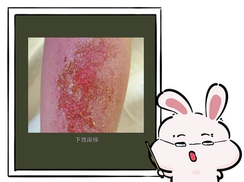 异位性皮炎症状图图片