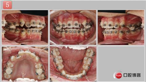 11-牙齿重度拥挤 减数4颗前磨牙-张世伟的博客-KQ88口腔博客