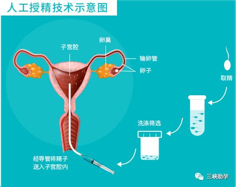 人工受精对医院的要求高吗 怎么选择人工生殖的治疗方式 _八宝网