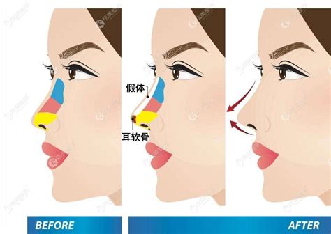 耳朵软骨突出图片