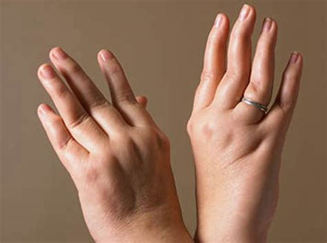 【右手中指关节肿痛】【图】右手中指关节肿痛怎么办 两大方面分析治疗方法_伊秀健康|yxlady.com