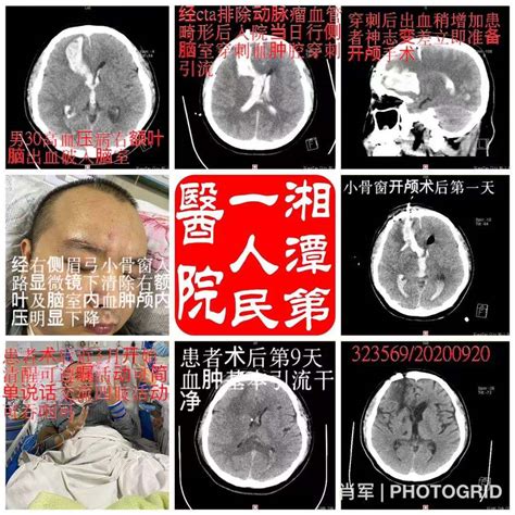 神外完成一例高血压脑出血（9.20）-湘潭市第一人民医院