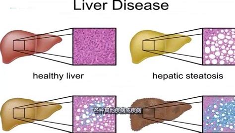 肝功能衰竭的首要症状 肝脏具有合成、解毒、代谢、分泌、生物转_新浪新闻