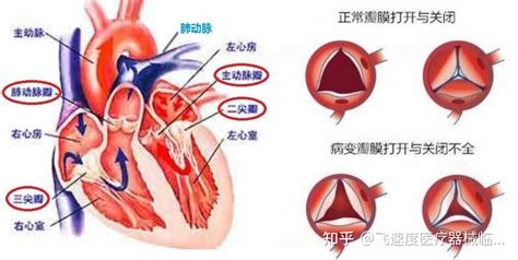全球首例!“深圳核心医疗Corheart6超小型人工心脏植入手术”成功实施