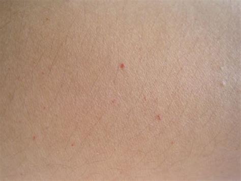 皮肤上长出这4种小红点，虽然不痛不痒，或是疾病的信号