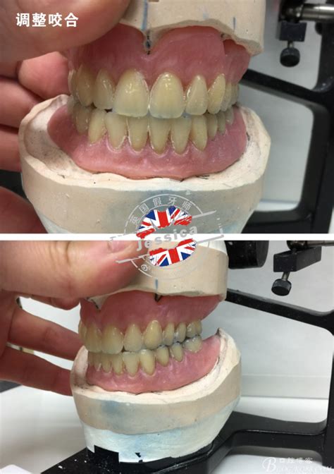 分享我制作活动义齿案例2（全口义齿）-英国假牙师的博客-KQ88口腔博客