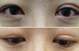 双眼皮失败症状以及如何修复？肉条、大小眼、过宽过窄 - 知乎