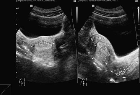 病例3 正常子宫(黄体期)-妇产超声读片-医学
