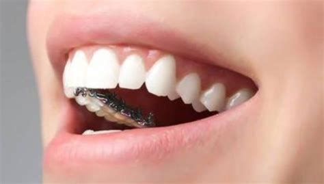 儿童牙齿反颌矫正器图,恒牙,年龄_大山谷图库