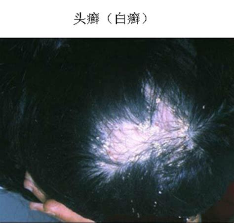 白癣图片