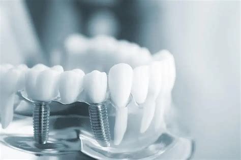 你清楚种植牙的过程是怎么的吗？ | 升艺口腔医院