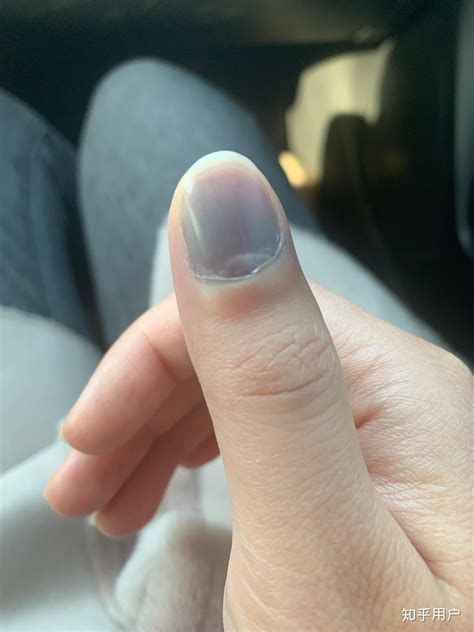 手指一遇冷就刺痛变色，1年后长沙阿姨的指端溃烂了 - 科普知识 - 长沙市第三医院
