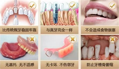 对比树脂贴面和全瓷贴面的区别,价格和维持时间都有差异呢 - 口腔资讯 - 牙齿矫正网