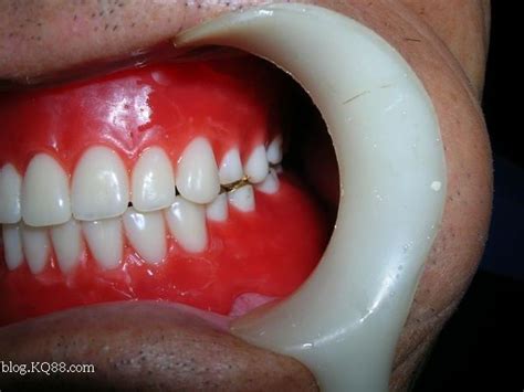 我给患者做的全口义齿-杨宪刚的博客-KQ88口腔博客