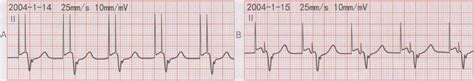 心电图图例分析：心房起搏心律AAI模式 - 爱爱医医学网