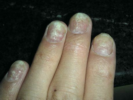 灰指甲的主要原因有哪些_灰指甲原因_大成皮肤网