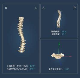 基于姿态编码器的2D/3D脊椎医学图像实时配准方法