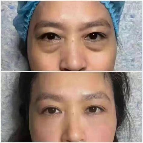 女性40岁以后还想年轻，面部抗衰老，离不开的9个医美项目 - 妆知道