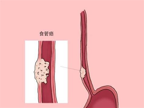 食道图片