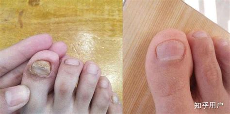 【脚指甲变灰】【图】脚指甲变灰是怎么回事 预防治疗是关键(2)_伊秀健康|yxlady.com