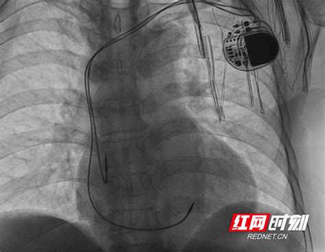 清华大学第一附属医院首例无导线起搏器植入手术成功实施-清华大学