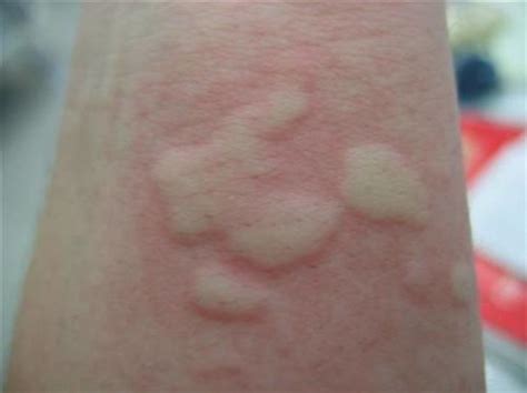 深圳肤康皮肤病专科：荨麻疹还痒吗？反复发作与自己有关！__财经头条