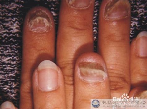 指甲长竖纹、白斑、黑线...是“疾病征兆”？这些实情，现在知道还不晚__财经头条