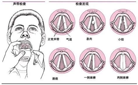 喉咙正常图片