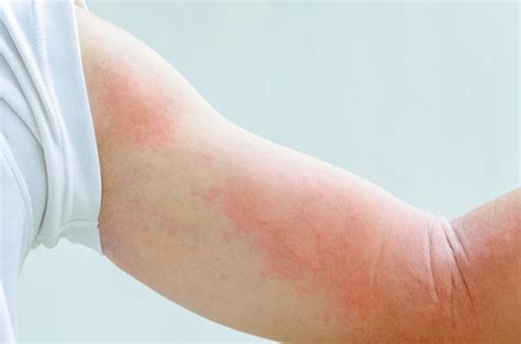 过敏季节，医生教您辨别荨麻疹和湿疹_澎湃号·湃客_澎湃新闻-The Paper
