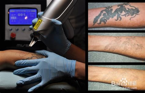 激光洗纹身后应注意的十大事项-百度经验