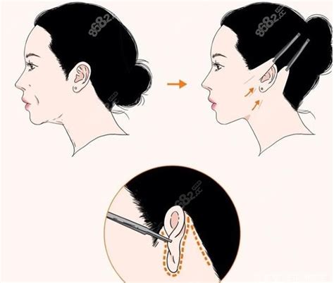 颈部拉皮手术多少钱?做过颈部拉皮的人分享费用,切口和过程,除皱对比照-8682赴韩整形网