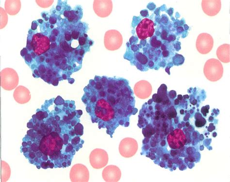 图294 原发性海蓝组织细胞增生症骨髓象(集中视野)-血液学细胞学-医学