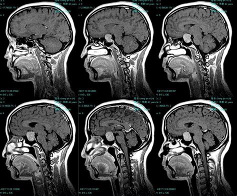 头部CT和MRI检查有什么区别-