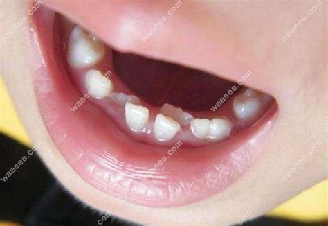 孩子六七岁换牙新牙长歪了怎么办?小心后悔给小孩牙齿矫正 - 口腔资讯 - 牙齿矫正网
